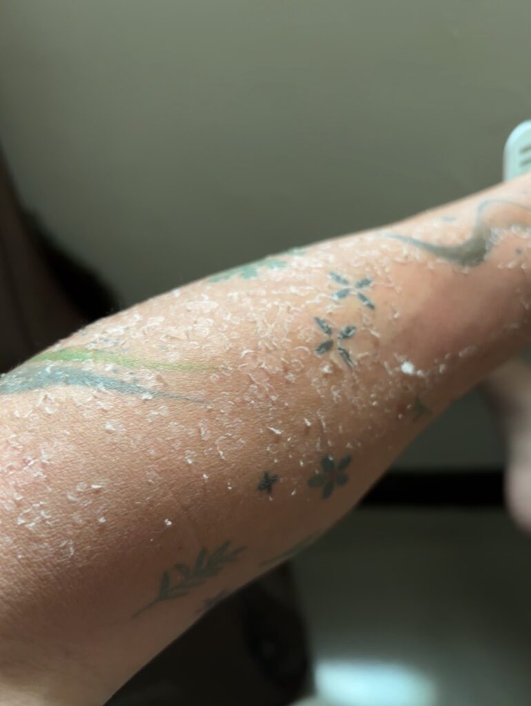 在海拔3000米以上，沒有做好防曬就會嚴重曬傷，渾身發熱嚴重影響睡眠恢復